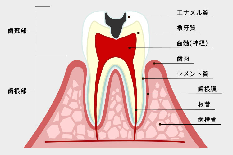 虫歯のイメージ画像