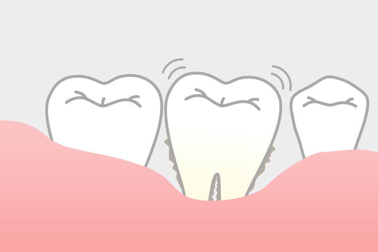 歯周病のイメージ画像