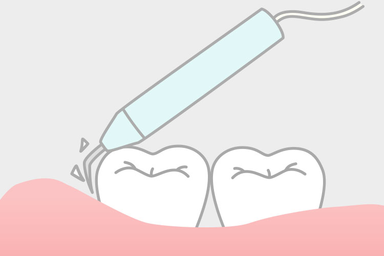 歯周病治療のイメージ画像