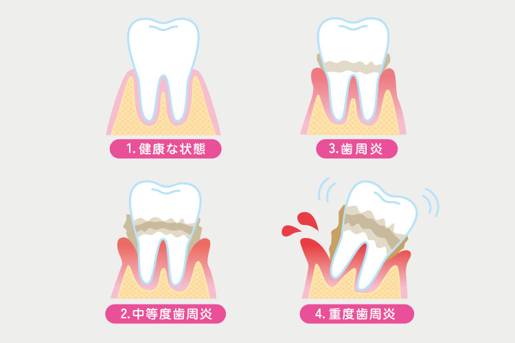 歯周病の進行状況イメージ画像