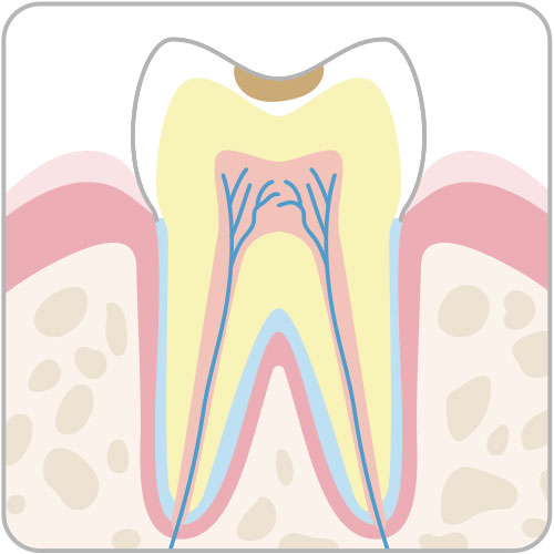 表面の虫歯