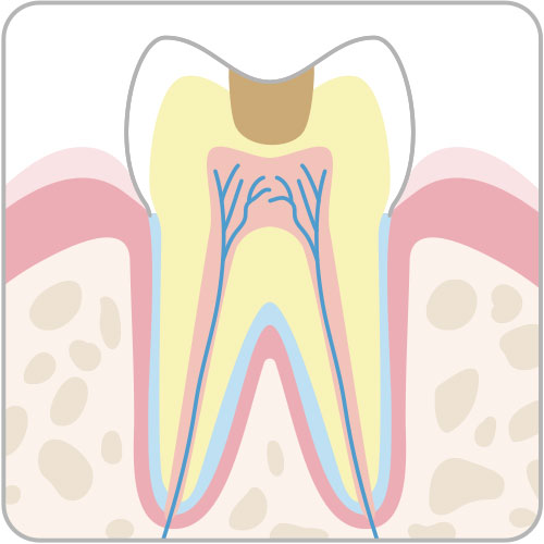 内面の虫歯