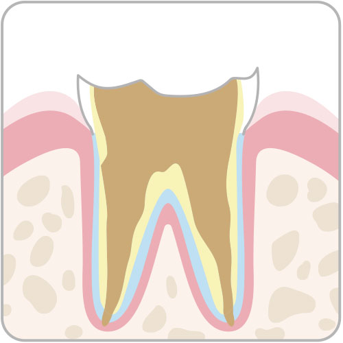 歯の根元だけ残っている虫歯